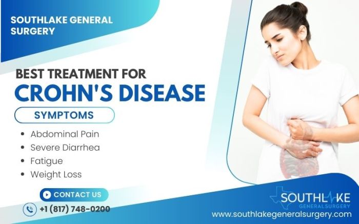 Best Treatment for Crohn's Disease: Expert Options - Southlake General ...