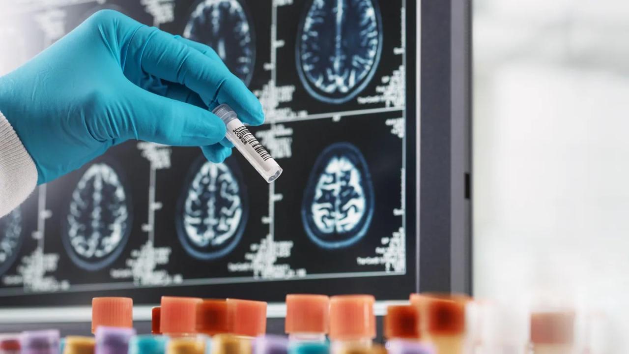 What Are the Latest Trends in Multiple Sclerosis Treatment? What Are the Latest Trends in Multiple Sclerosis Treatment?